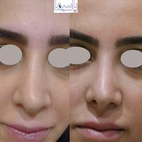 اصلاح فرم بینی با تزریق ژل انجام شده توسط متخصص پوست دکتر رقیه جبرئیلی