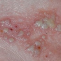 علت تاول زدن پوست چیست؟