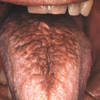 عکس زبان مودار (Hairy Tongue)